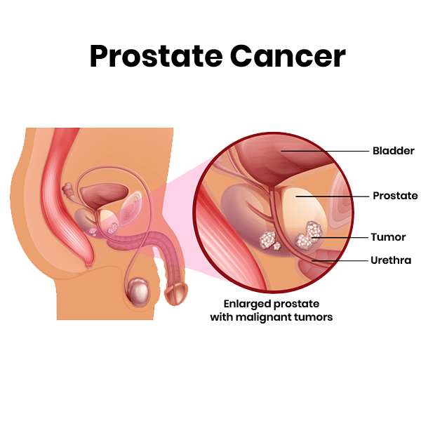 prostate cancer treatment early detection